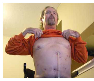 Former shipyard worker James Sawyer, 53, needed a double lung transplant to treat hard-metal disease.